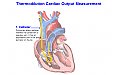 Cardiac output measurement - Thermodilution