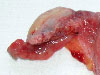 Onkogynekologie II - Zhoubné nádory dělohy a vulvy