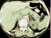CT břicha (se zaměřením na játra a žlučové cesty)
