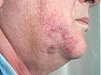 Dermatomycoses-English