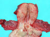 Onkogynekologie I - Karcinom děložního hrdla