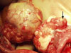 Onkogynekologie III - Zhoubné nádory ovária