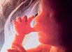 Preeklampsie - Patologické stavy v těhotenství III