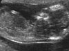 Současné metody prenatálního screeningu a nejčastější vrozené vady plodu