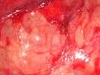 Urolitiáza, tumory ledvin, obstrukce močových cest