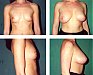 Základy mamologie II - karcinom prsu